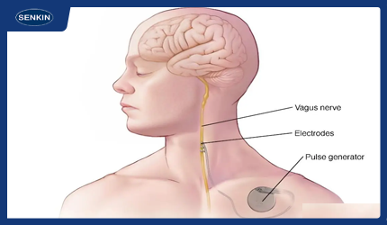 部脑刺激（DBS）导线核心材料：铂铱合金线与MP35N电线